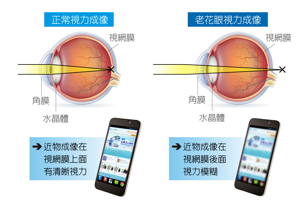 老花眼的症状【初期】约50-100度   看报纸,手机时会有视力模糊的